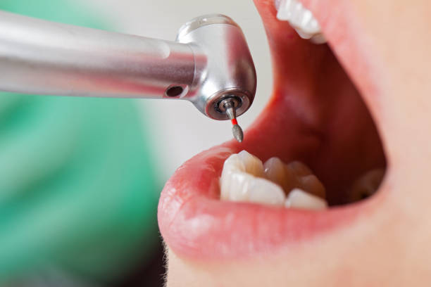 Best Urgent Care for Lost Fillings or Crowns in Clover, SC